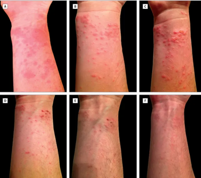 symptoms of jellyfish sting